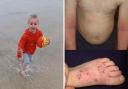 Ezra playing at the beach (left) and his skin when he experienced a flare-up. Picture: Eczema Outreach Support