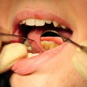 Residents in Somerset are unable to register as new NHS dentist patients for routine care, a patient champion organisation has claimed. Picture: Rui Vieira, PA Wire