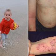 Ezra playing at the beach (left) and his skin when he experienced a flare-up. Picture: Eczema Outreach Support
